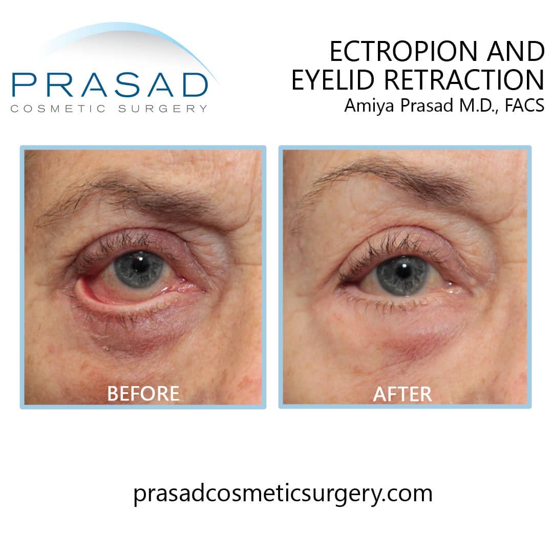 Can Eye Bag Surgery Go Wrong Dr Prasad Blog