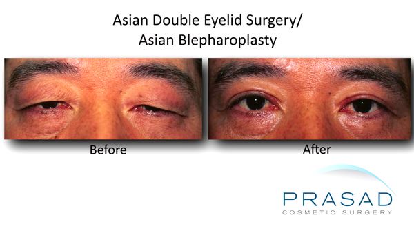 Upper eyelid surgery- Dr Prasad Asian Double Eyelid Surgery Asian Blepharoplasty Older Male Upper Eyelift Surgery