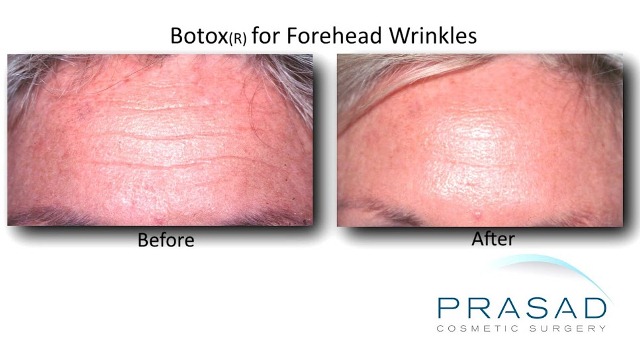 Botox New York Cosmetic Injections Dr Prasad