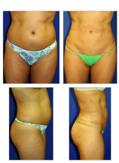 Liposuction Before and After Photos