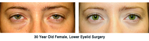 Lower Eyelid Surgery Before and After Lower Eyelift Surgery New York Before and After