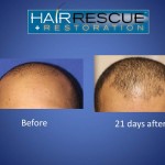 Acell Case Study Patient 1 Photo 1