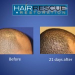 Acell Case Study Patient 1  Photo 2