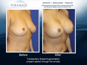 Breast Augmentation surgery After Childbirth