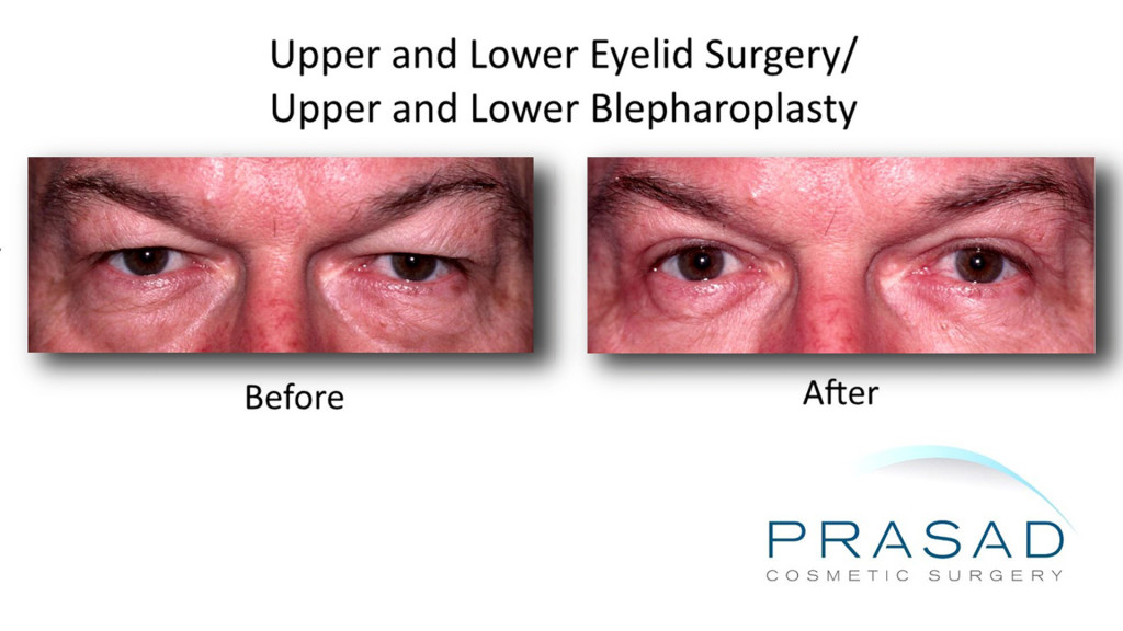 Blepharoplasty- Dr Amiya Prasad Upper and Lower Eyelid Surgery before and after male Caucasian 1024x576 Upper Eyelift Surgery