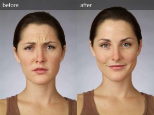 botox2 Botox Treatment for Wrinkle Reduction