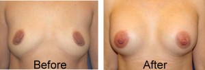 breast augmentation before and after underarm breast augmentation before and after