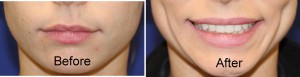 dimple creation surgery before and after