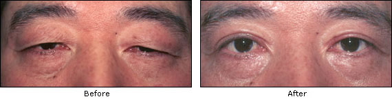 Before and After - Upper Eyelid lift Surgery Upper Eyelid Surgery Before and After