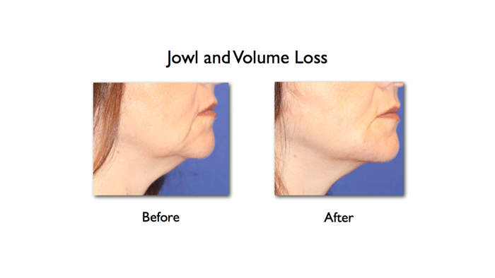 lower face enhancement of mandibular notch and mesolabial fold