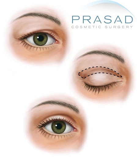 Eye lift surgery- Prasad Cosmetic Surgery prasad FIGURE 6 3 upper bleph watermarked 600w Upper Eyelift Surgery
