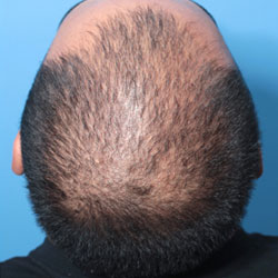 hair regeneration treatment on male in 20s