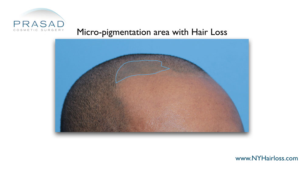 32-year-old man had scalp micropigmentation look unnatural and obvious