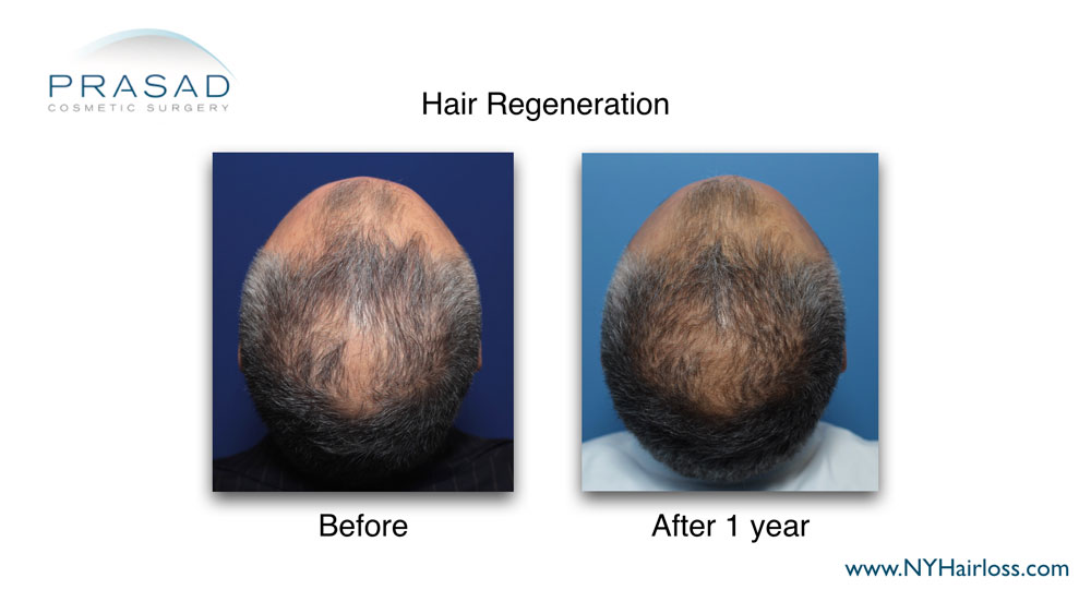 1 year after Hair Regeneration treatment on male pattern hair loss