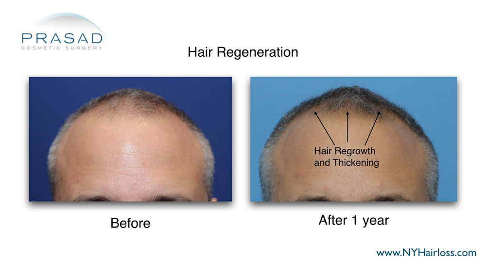 thicker hair 1 year after Hair Regeneration treatment