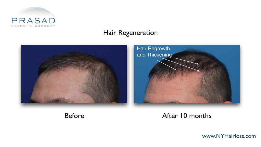 Before and 10 months after hair regeneration. Hair growth from dormant hair follicles at the frontal hairline and mid scalp are noticeable