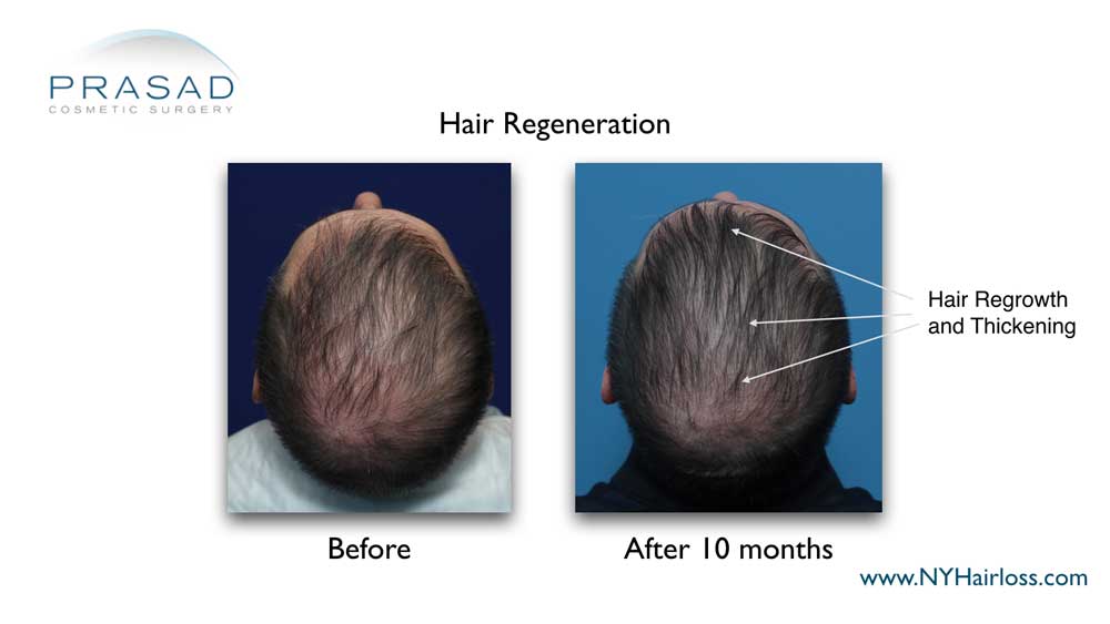 before and 10 months after hair regeneration. Hair regrowth and thickening 10 months after Hair Regeneration treatment