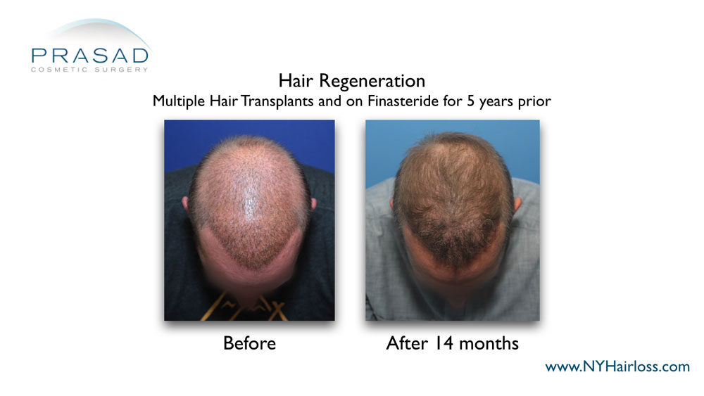 before and 14 months after Hair Regeneration thickened the thinning hair of the male patient