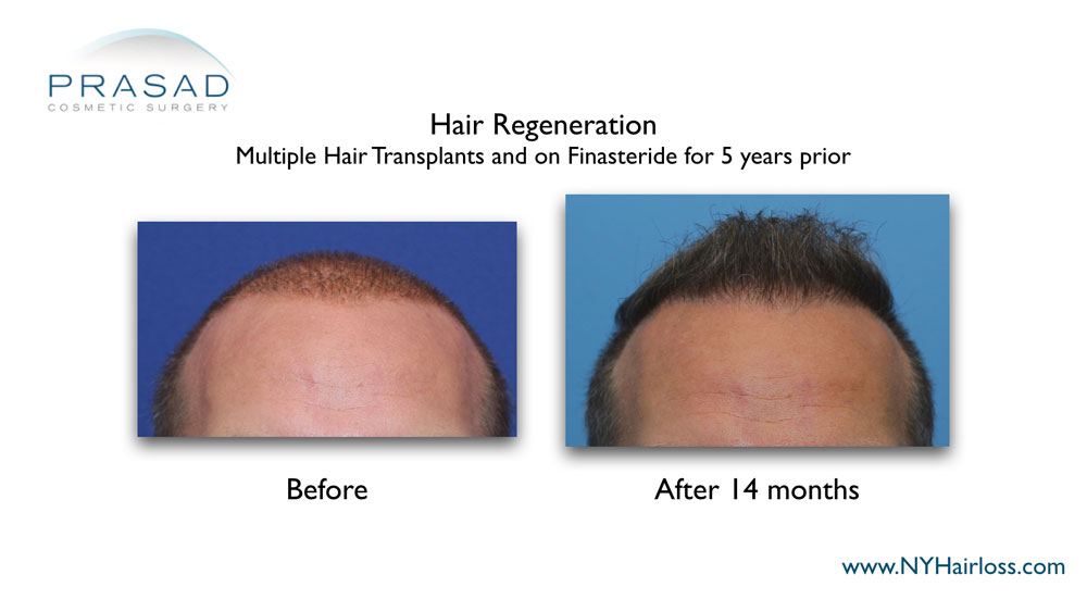 before and 14 months after hair regeneration. Patient had multiple hair transplant and on Finasteride prior to the treatment