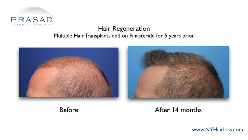 Before and 14 months after Hair Regeneration. Male patient left side view
