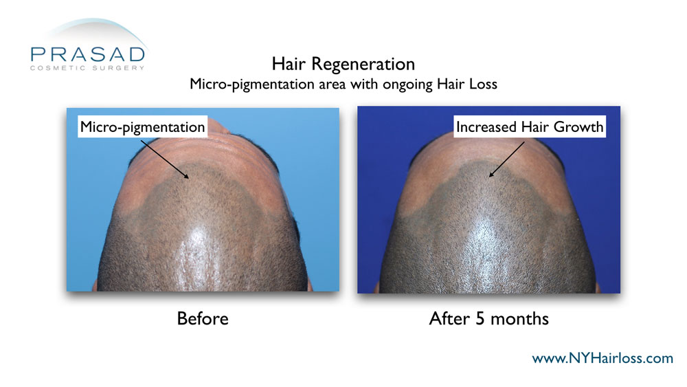 5 months after Hair Regeneration treatment scalp micropigmentation blend better with increased hair coverage