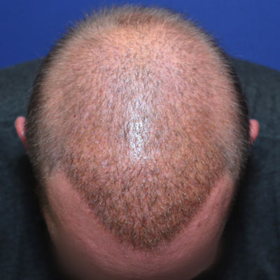 Improving scalp coverage and density after multiple hair transplants -  Prasad Cosmetic Surgery