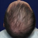 Late-Onset-Hair-Loss-Treatment-without-Finasteride