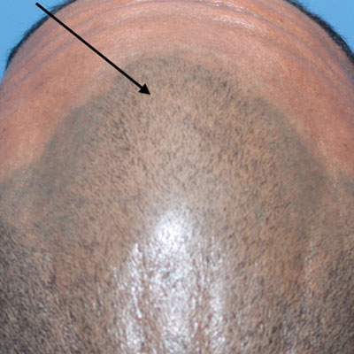 hair loss after scalp micropigmentation