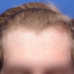 hair loss on male early 20s