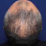 Treating-late-onset-pattern-hair-loss-without-finasteride