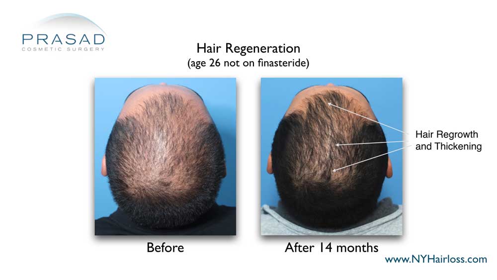 before and 14 months after one time Hair Regeneration Treatment