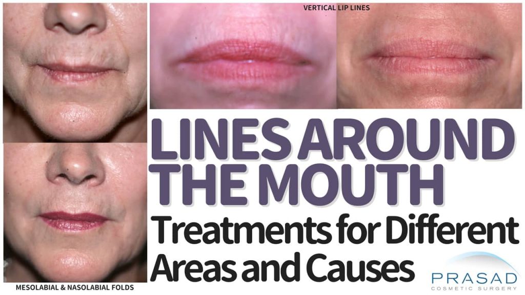 how to treat lines around the mouth