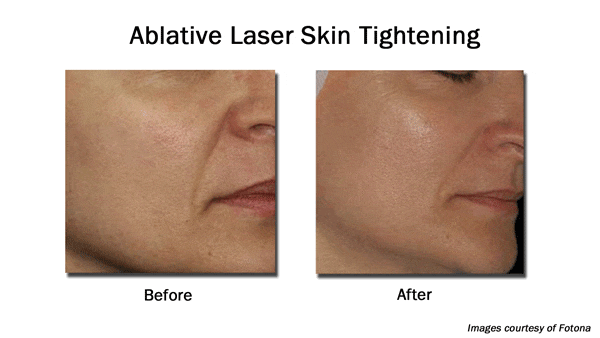 before and after Ablative laser skin resurfacing on face