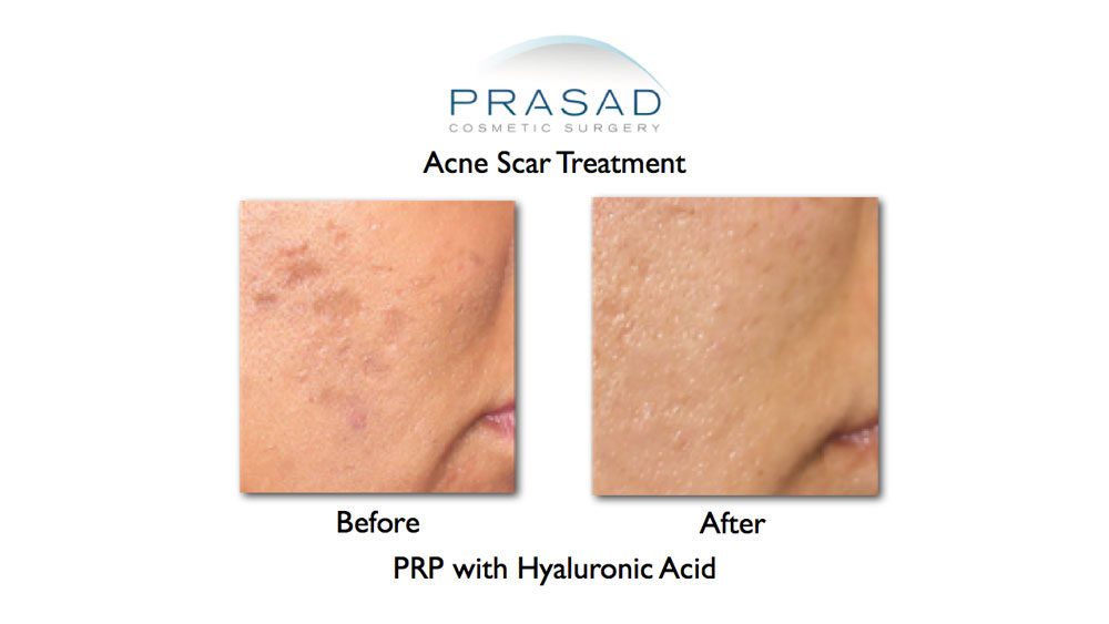 before and after prp treatment for acne scars - female right cheek