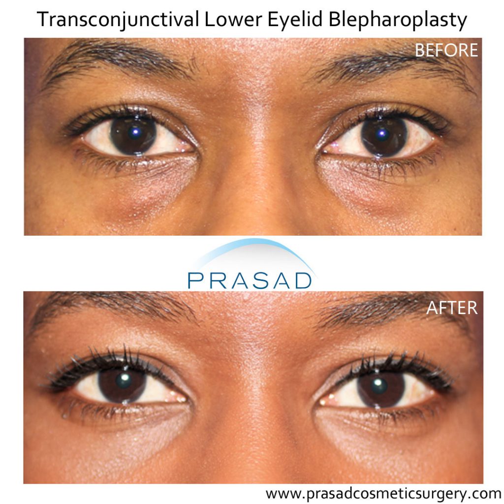 lower eyelid surgery before and after female dark skin patient