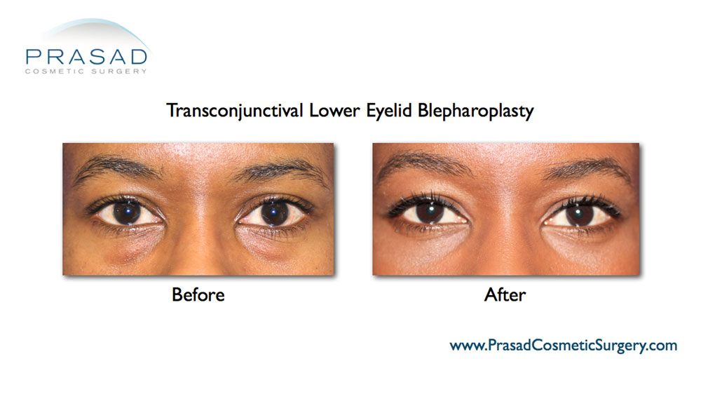 lower eyelid surgery before and after female dark skin patient