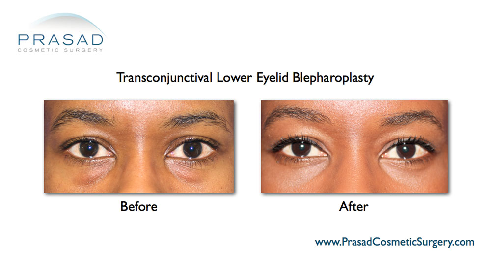 Lower Blepharoplasty Before and After Photos