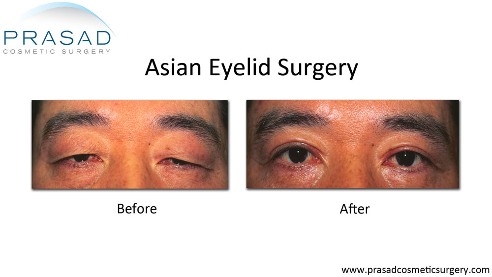 Before and after Asian eyelid surgery on male patient using incisional method