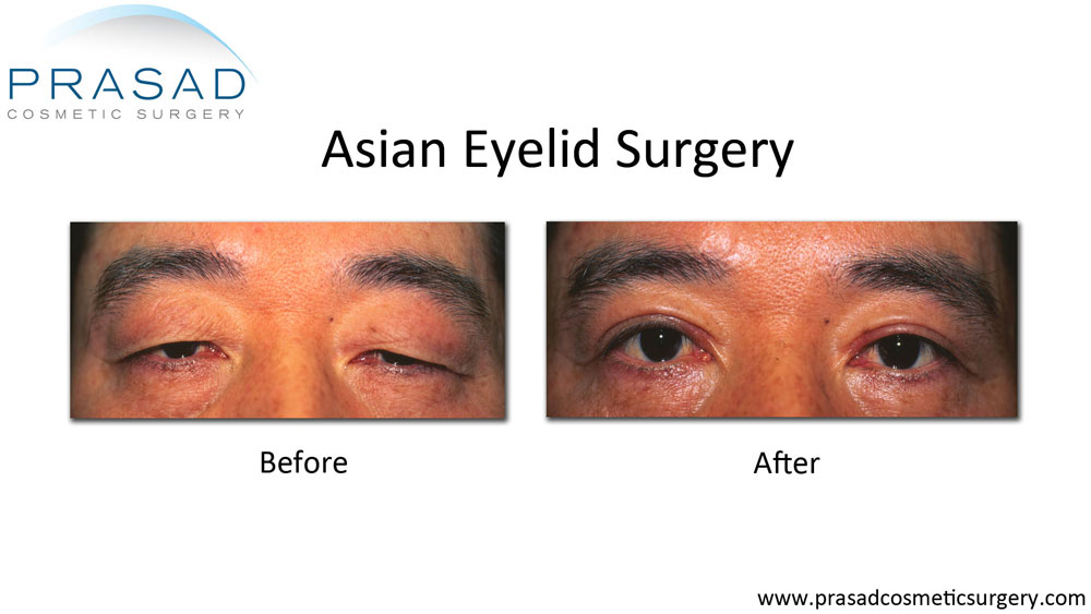 Double Eyelid Surgery Before and After Photos