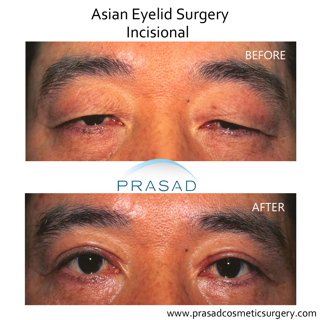 incisional double eyelid surgery performed on male patient, before and after results
