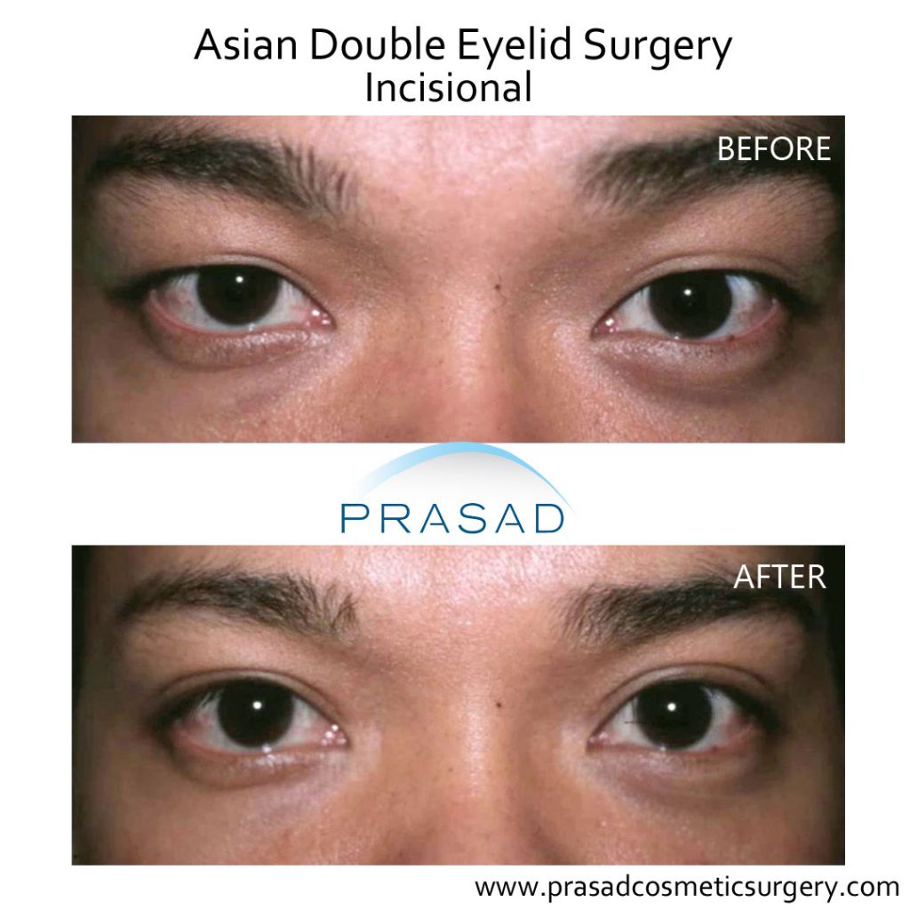 incisional asian double eyelid surgery before and after male