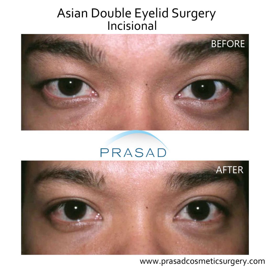 How is a Double Eyelid Eyelid Crease Created Dr. Prasad Blog