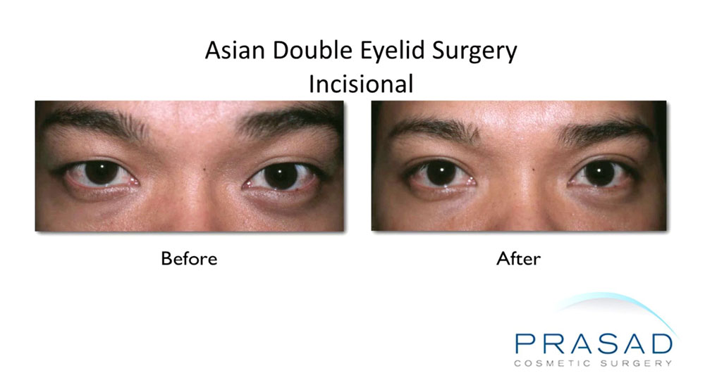 before and after Asian double eyelid surgery using Incisional procedure technique