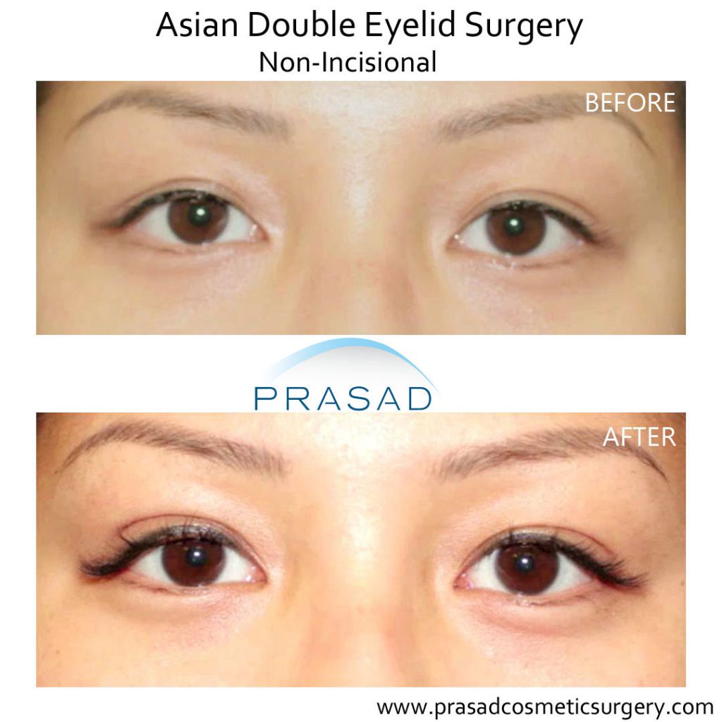 before and after non-incisional double eyelid surgery performed on female patient