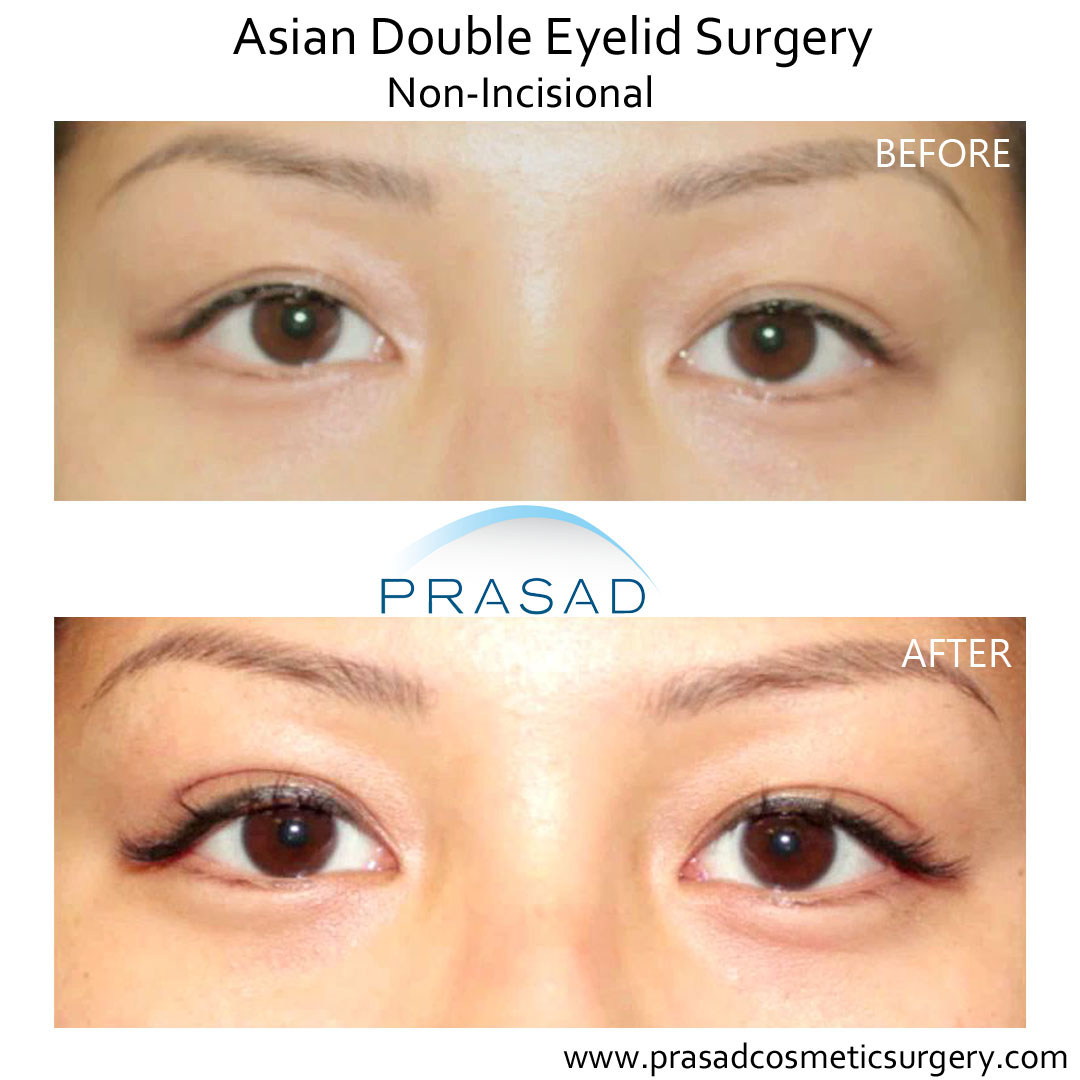 Epicanthic fold surgery before and clearance after