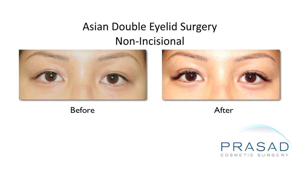 before and after non-incisional double eyelid surgery performed on female patient