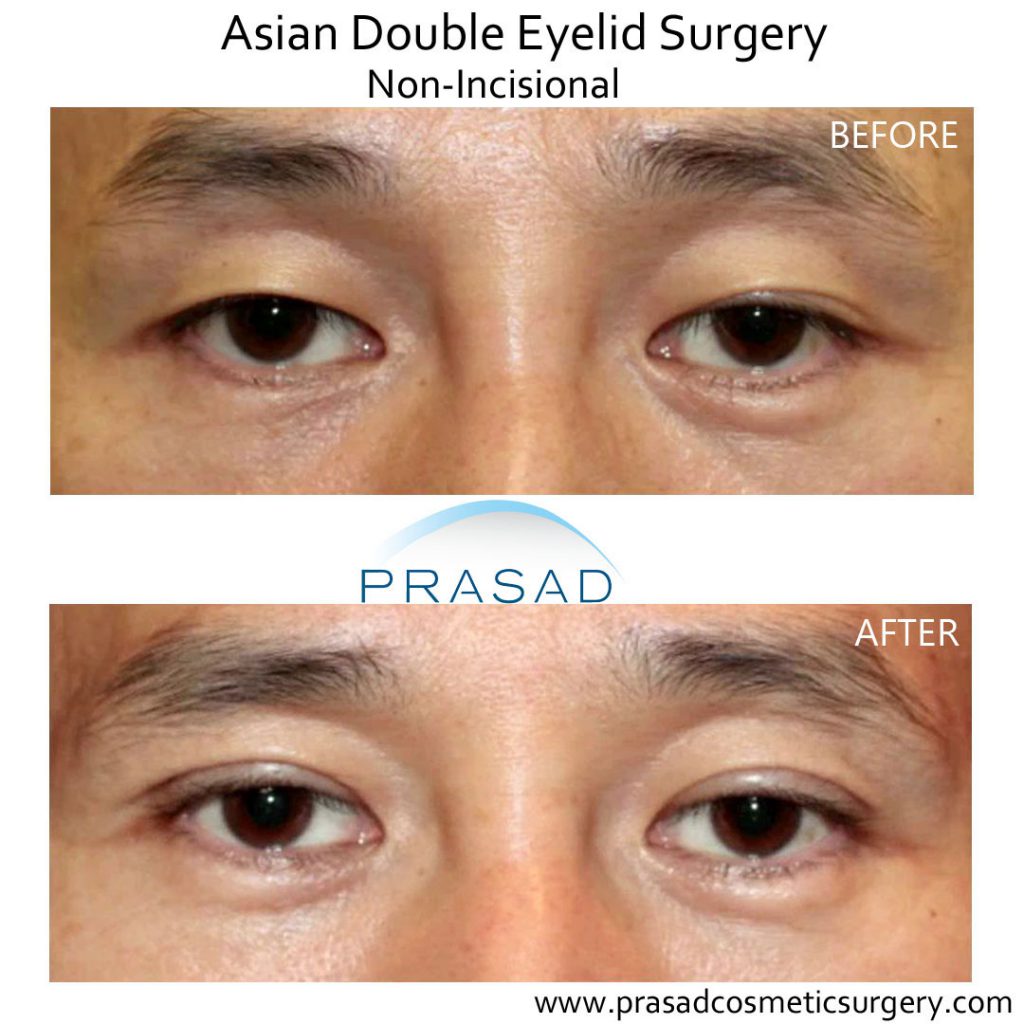 double eyelid surgery male patient before and after results