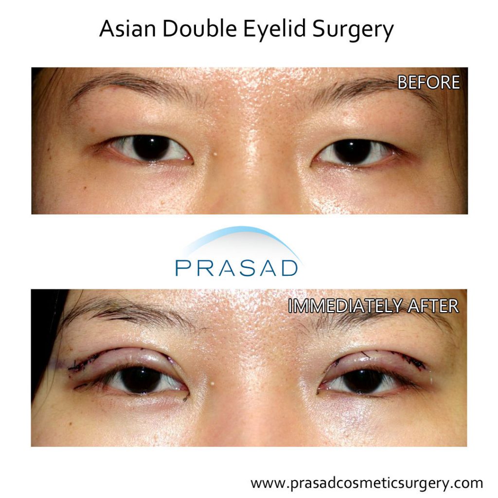 korean double eyelid surgery before and immediately after surgery photo