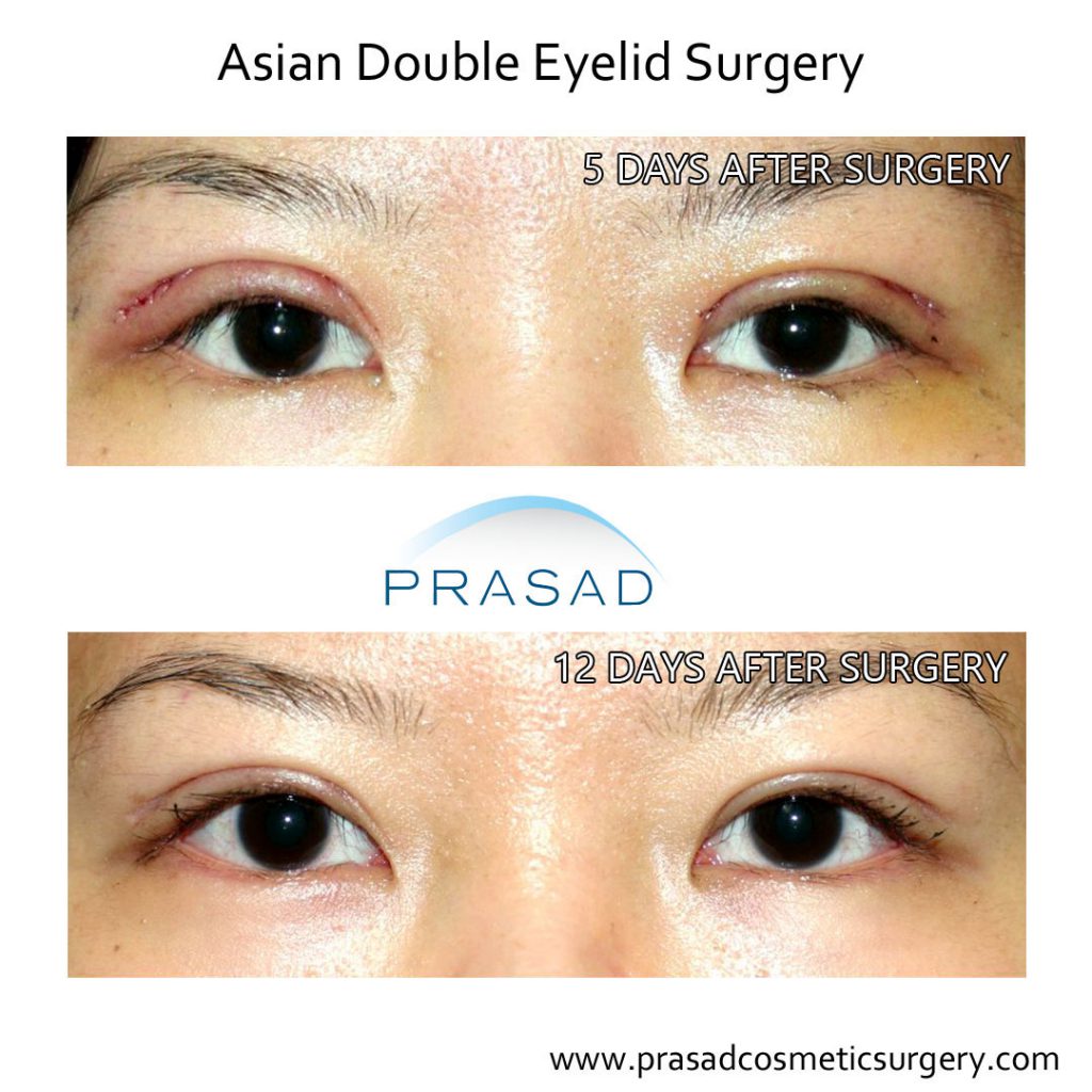 korean double eyelid surgery before and 2 weeks after recovery photo