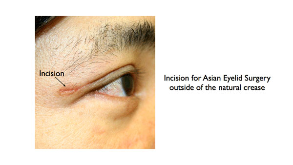 Incision for Asian Eyelid Surgery outside of the natural crease illustration